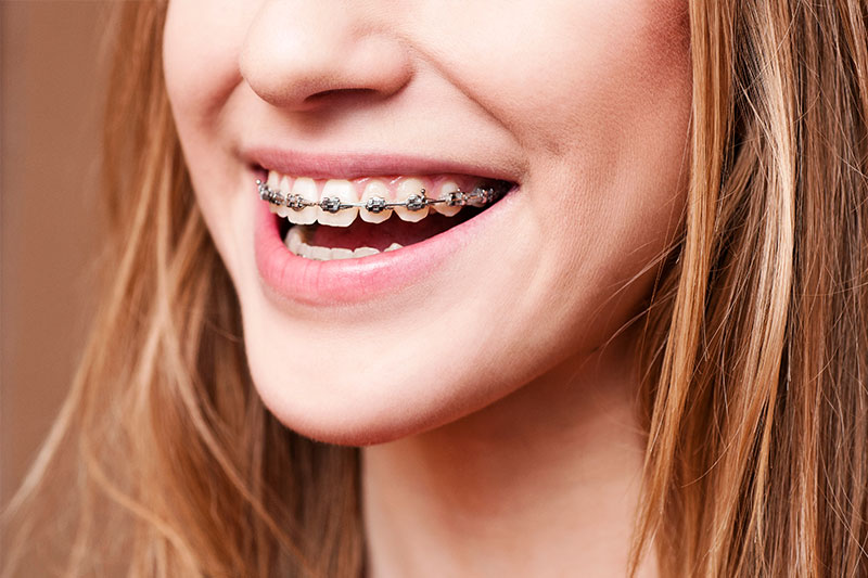 Orthodontics - Align Dental & Orthodontics , Altamonte Springs Dentist