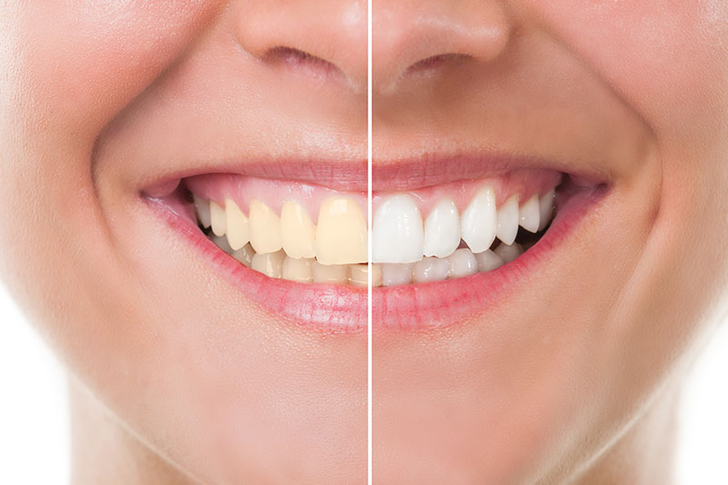 Teeth Whitening - Align Dental & Orthodontics , Altamonte Springs Dentist
